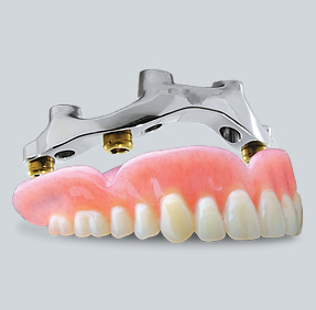 Implant and hybrid denture with overbar