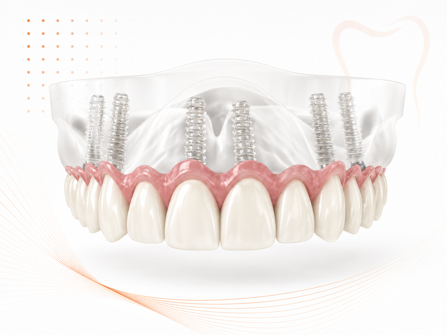 Full-arch hybrid implant restorations