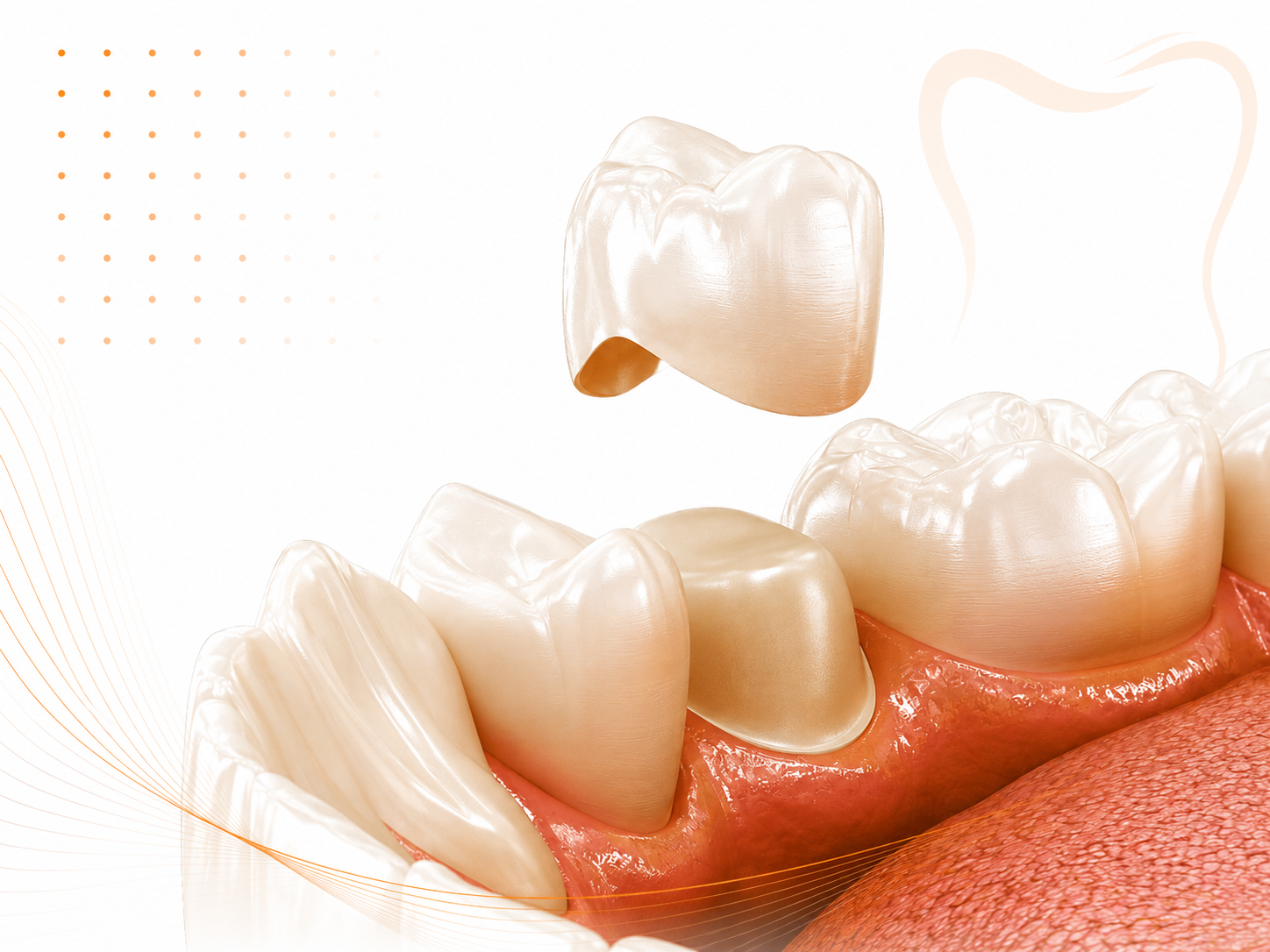 Zirconia and all-ceramic dental restorations