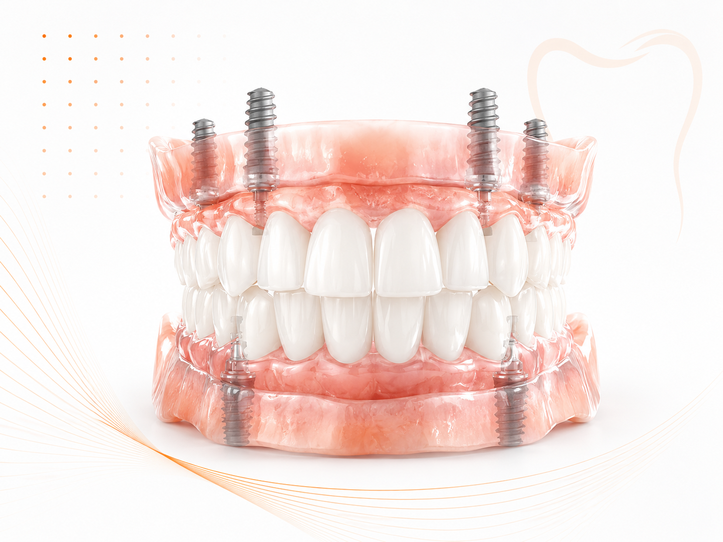 Single and multi-unit implant restorations