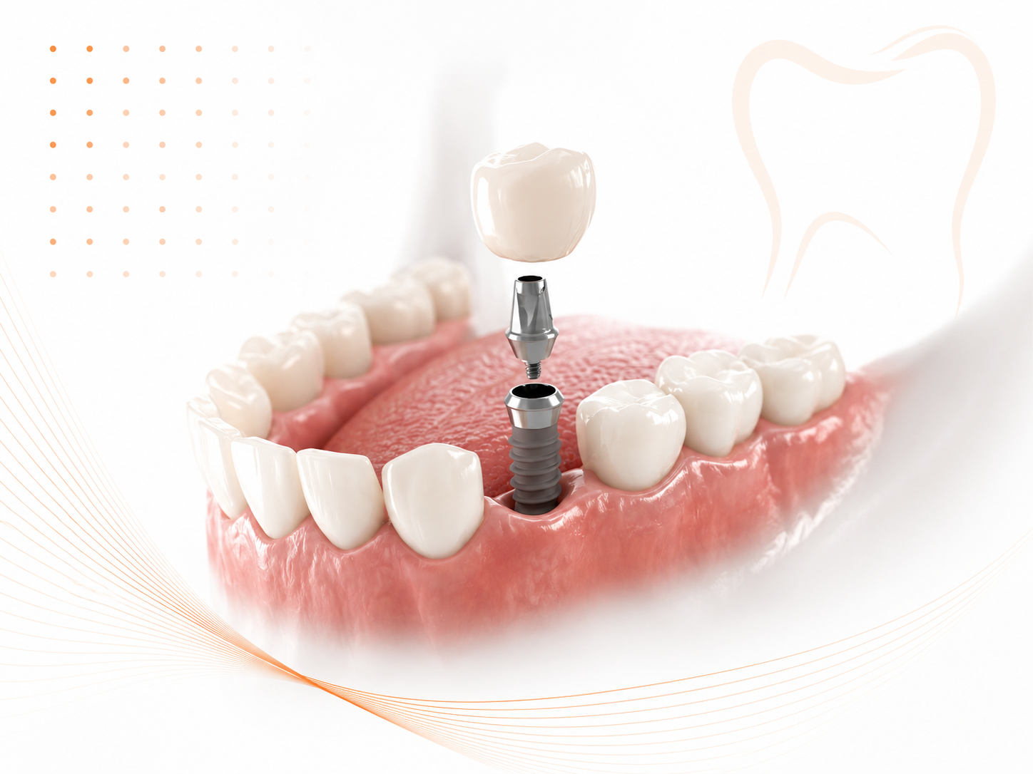 Dental implant and hybrid restorations